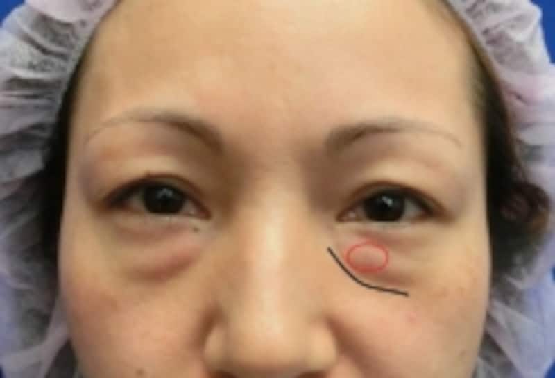 黒クマと赤クマが出ている方です。眼窩脂肪の突出もあります