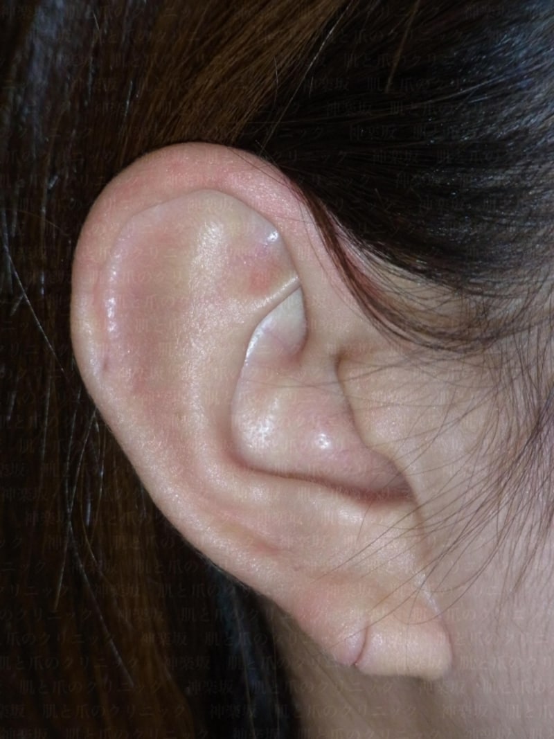ピアスで耳がちぎれた 裂けた 切れ耳 外傷性耳垂裂の治療と原因 皮膚 爪 髪の病気 All About