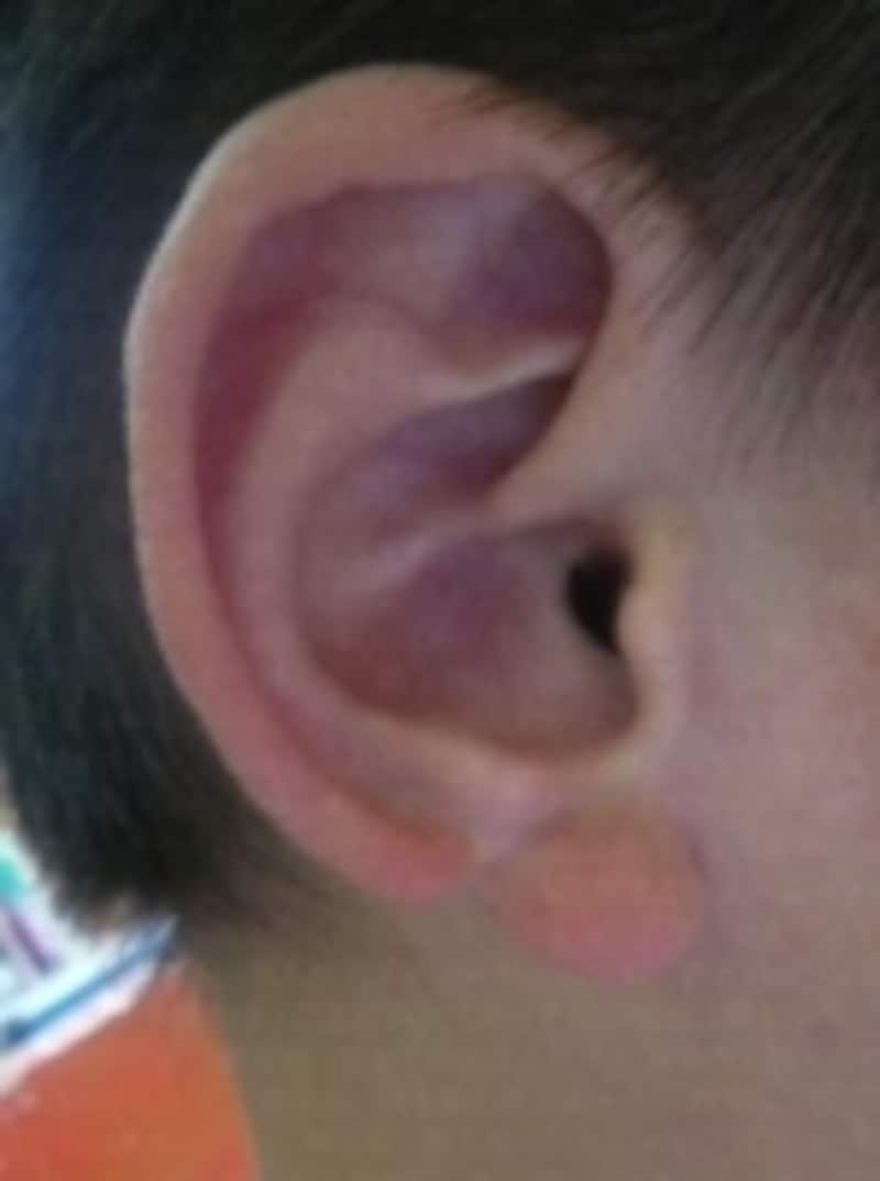 ピアスで耳がちぎれた・裂けた 切れ耳・外傷性耳垂裂の原因