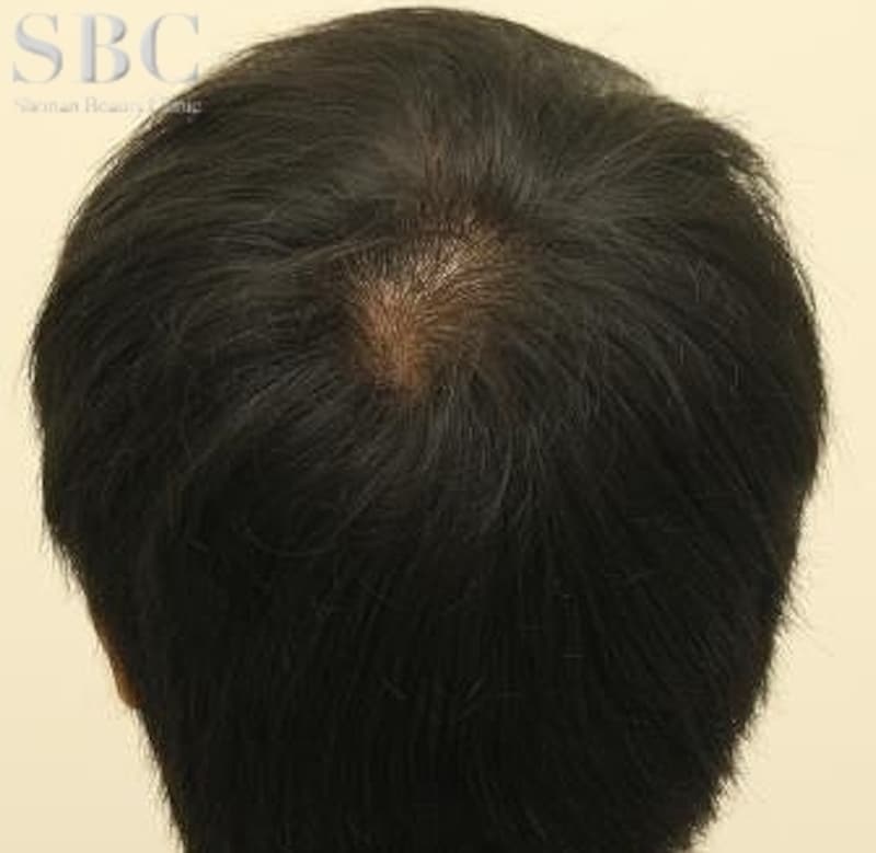 AGAの内服後7ヶ月