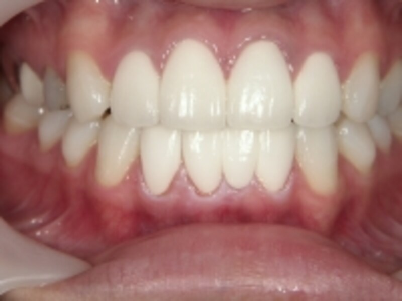 某野球選手のような、真っ白な歯！