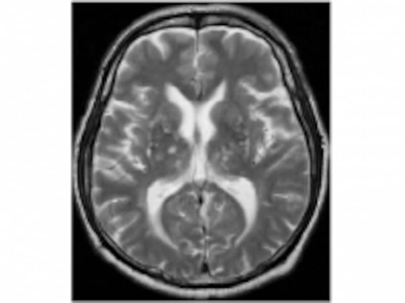 脳梗塞MR画像