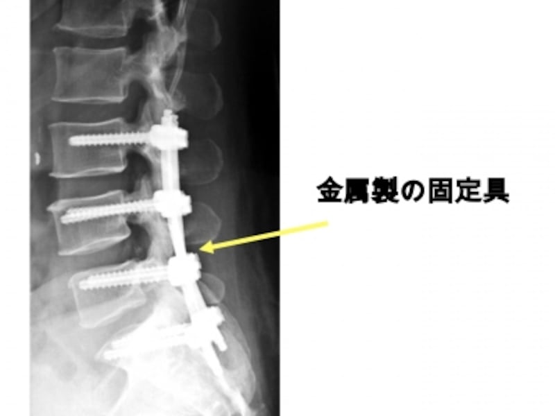 脊椎分離すべり症の診断 症状 治療 骨 筋肉 関節の病気 All About