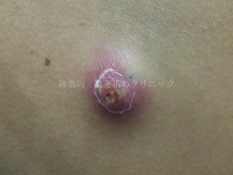 炎症性粉瘤