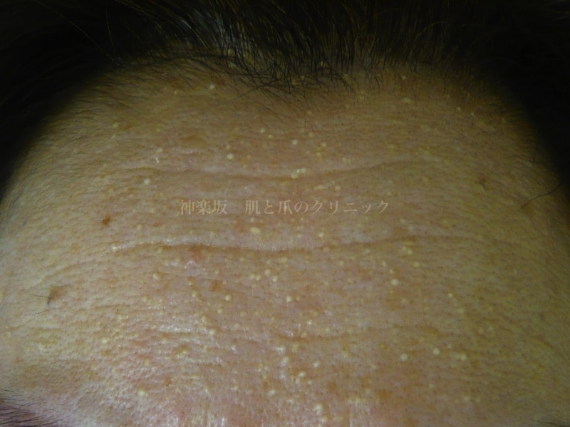 皮膚のできもの 母斑 粉瘤 脂肪腫など 皮膚 爪 髪の病気 All About