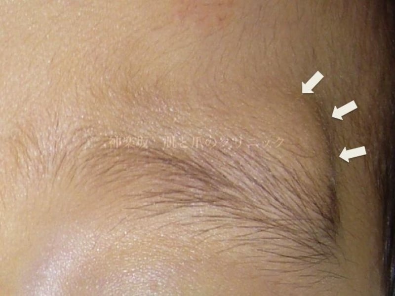 皮膚のできもの 母斑 粉瘤 脂肪腫など 皮膚 爪 髪の病気 All About