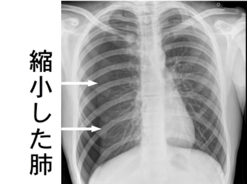 胸部X線。