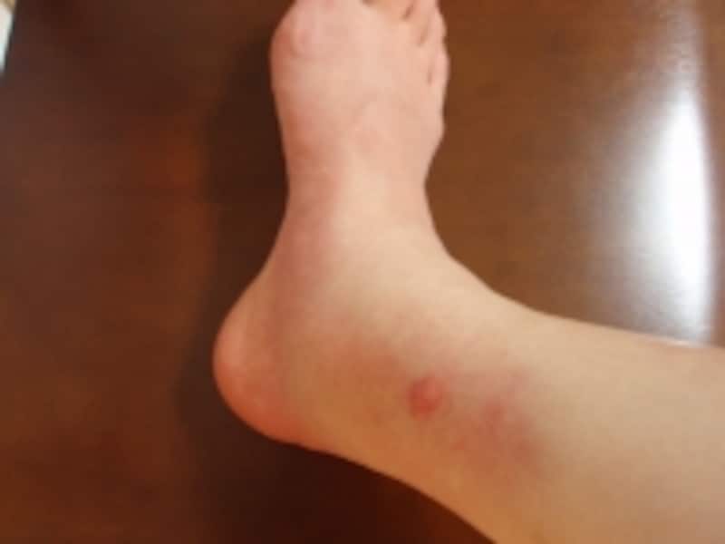 ブヨに刺されて腫れた足首