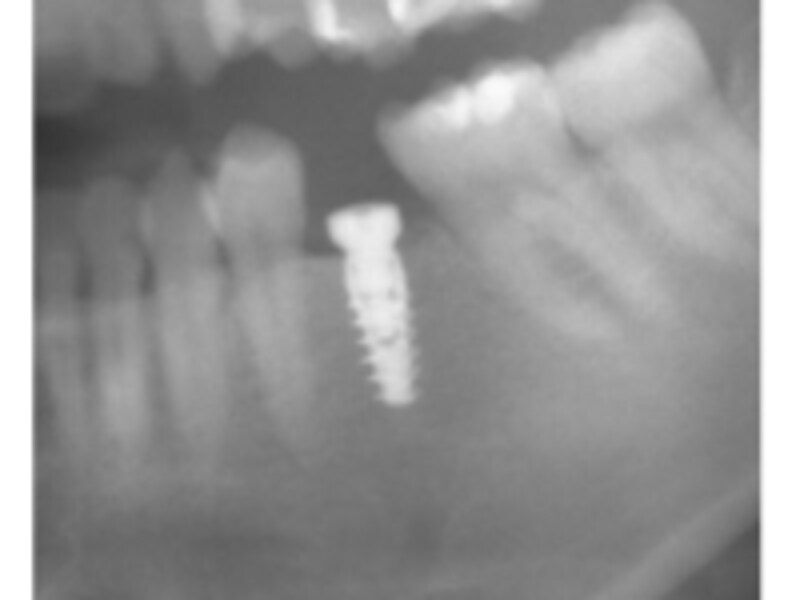 乳歯抜歯後のインプラント埋入