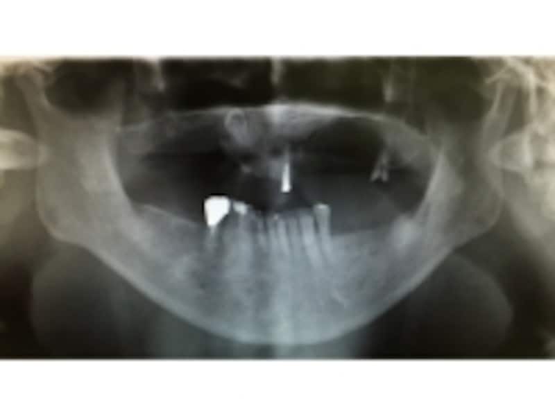 上顎左右2本の犬歯が埋没しているケースのレントゲン写真