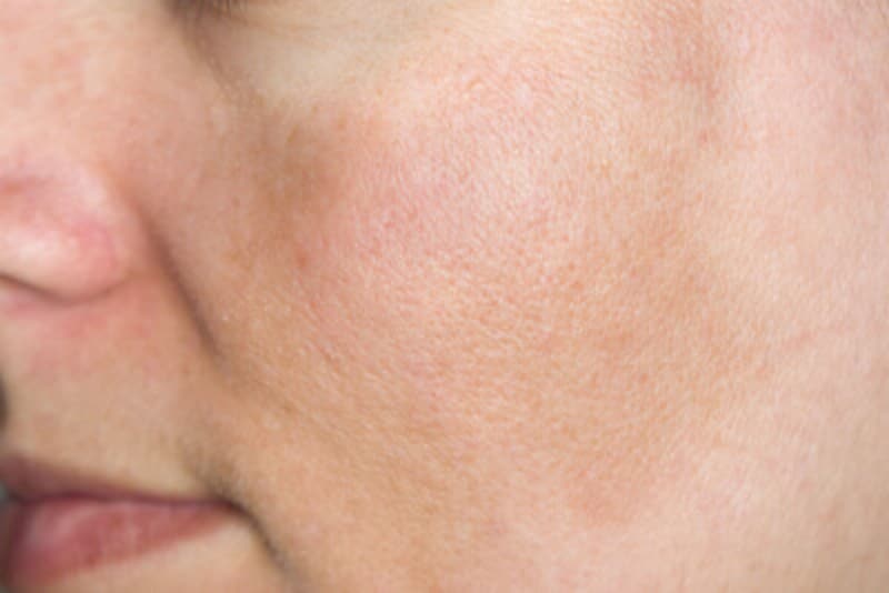 黒子(肝斑)はどのようにしてできるのですか?