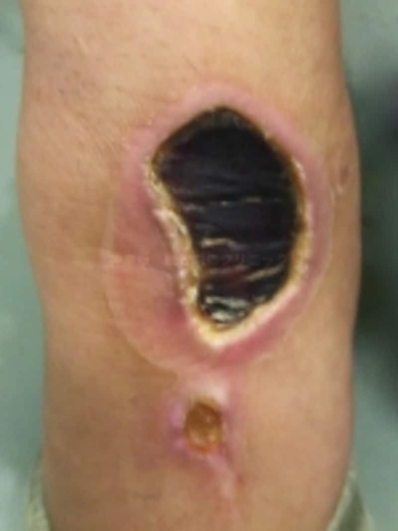 低温やけどundefined黒い壊死組織で覆われています。