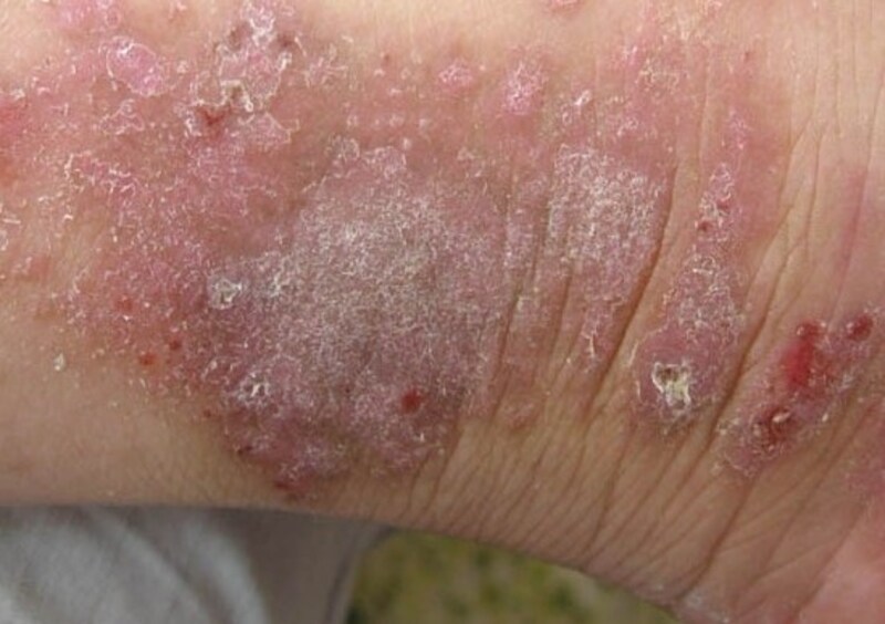 皮膚がんはかゆみがありますか?