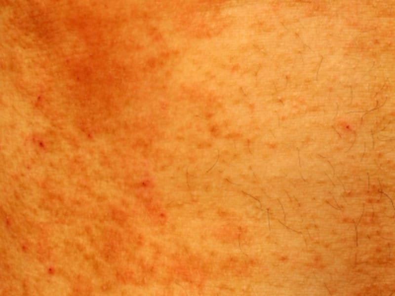 生後数ヶ月の湿疹予防が 全身のアレルギー予防に アトピー性皮膚炎 All About
