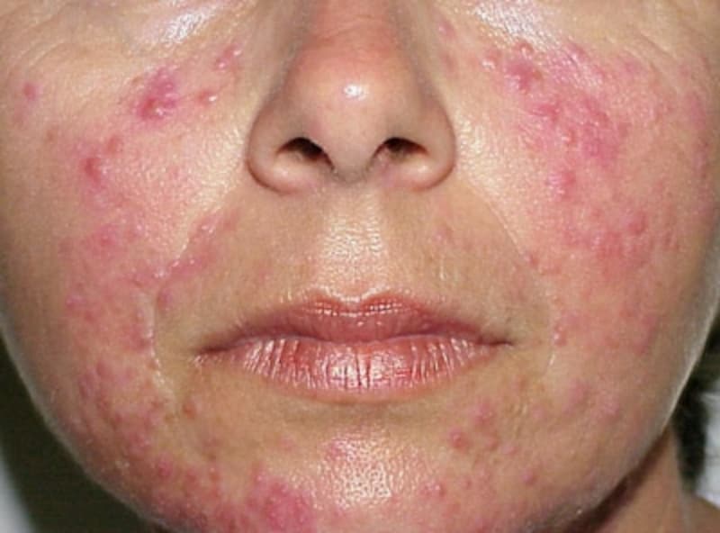 ニキビ レーザー 赤ら顔