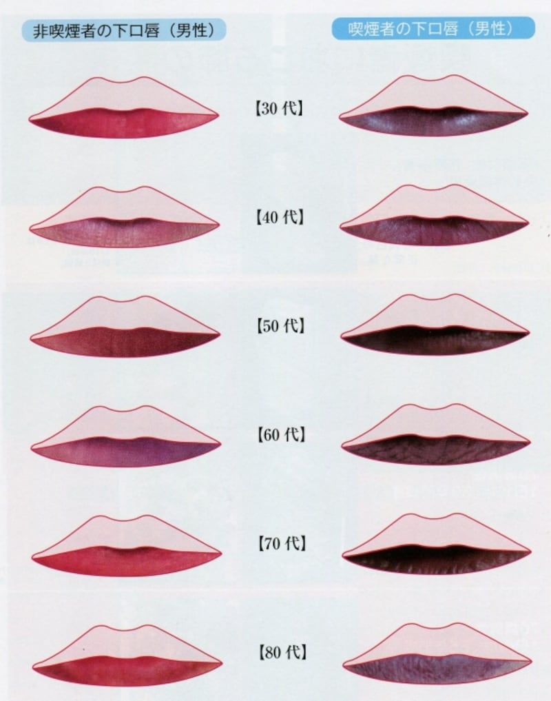 喫煙による口唇の変化