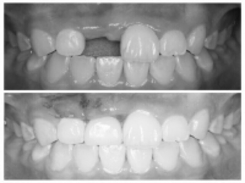 事故による部分的な欠損を補うには周りの綺麗な天然歯に負担をかけないインプラント治療が効果的
