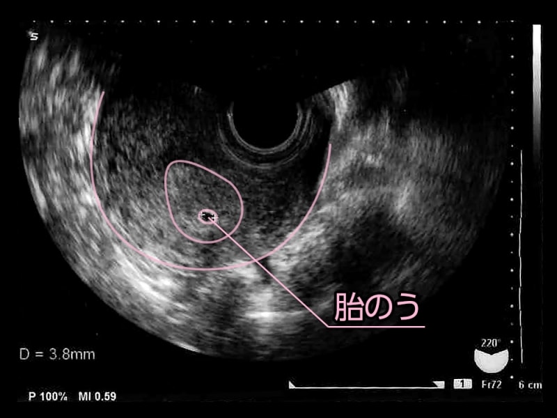 妊娠4週目（4w）、胎児のエコー写真・超音波写真