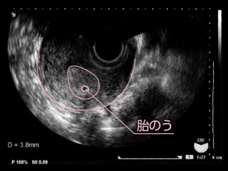 妊娠 初期 流産 兆候