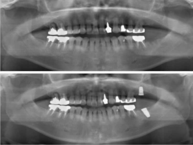上下とも第二大臼歯を喪失したケース。その他の奥歯も治療しているので過剰な負担を掛けないためにもインプラント治療を行った。