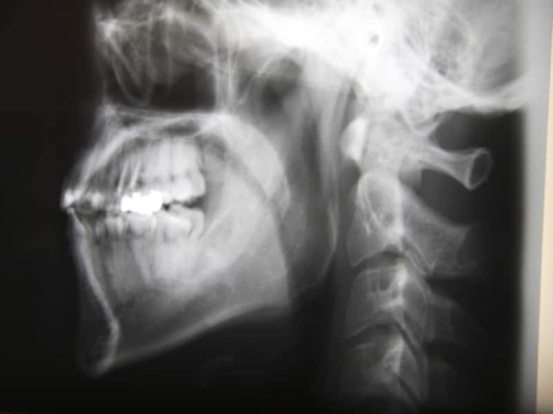 歯と鼻腔の位置的関係