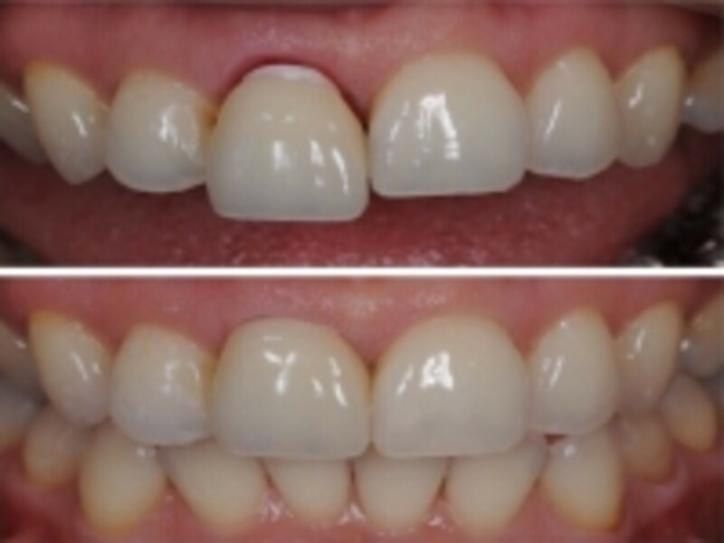 装着直後と3か月後