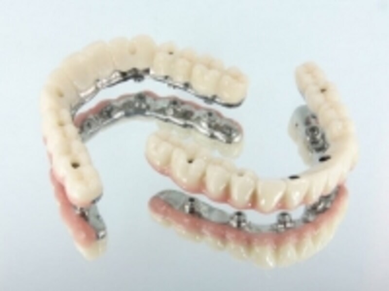 数本のインプラントで固定する上部構造