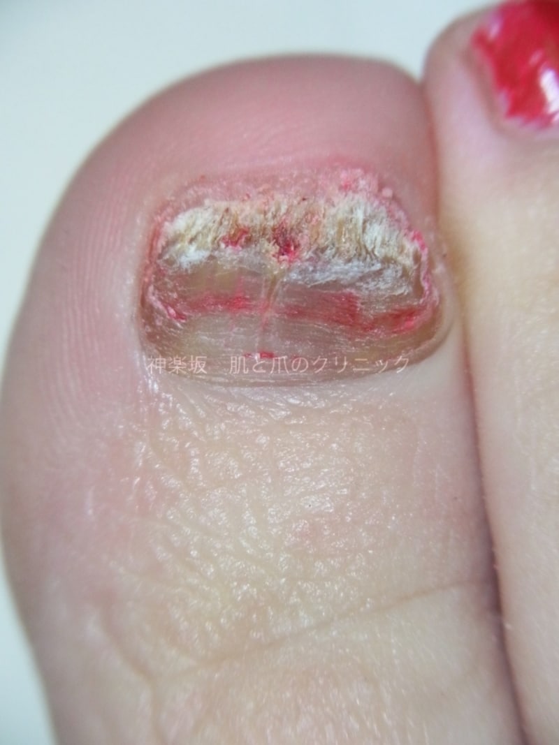 爪白癬undefined外用治療中