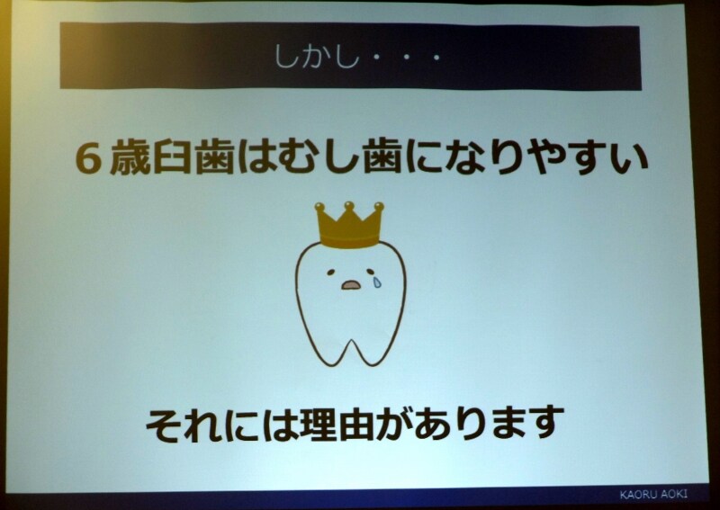 6歳臼歯は歯の王様だが、同時に虫歯にもなりやすい