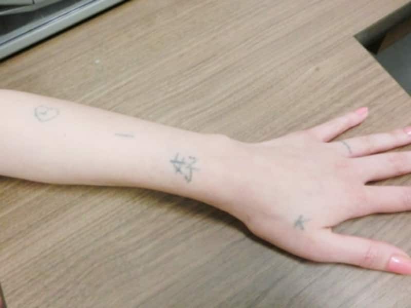 刺青は消せる レーザーでタトゥー除去治療体験記 美容医療 All About