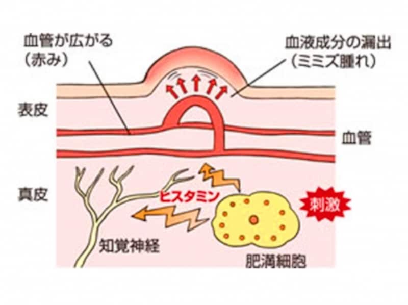 ホッとすると痒くなる じんましんはストレスが原因 スキンケア All About ホッとすると痒くなる じんましんはストレスが原因 スキンケア All About