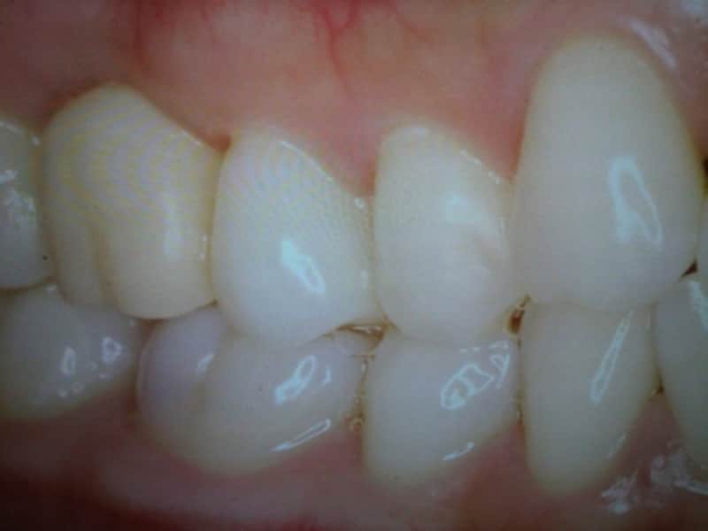 インプラント治療のゴール手前、仮歯の重要な役割とは？