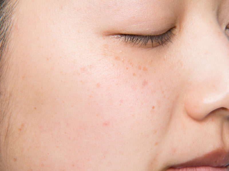 ビフォア。色ムラや毛穴が気になります。