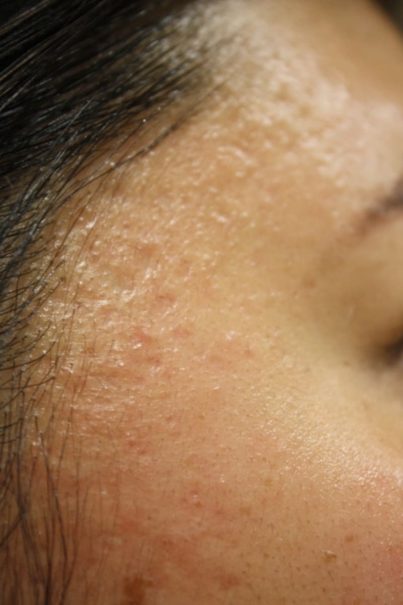 フラクショナルレーザー治療前