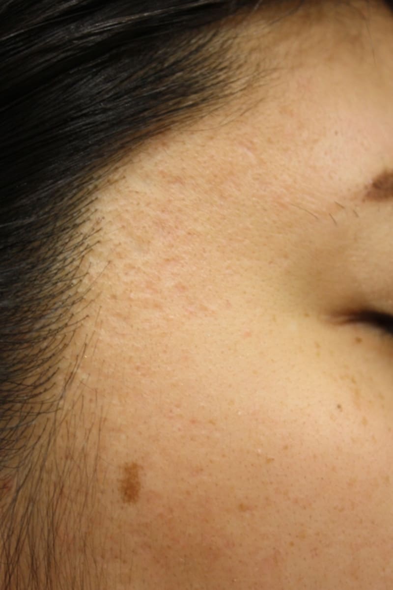 フラクショナルレーザー治療後