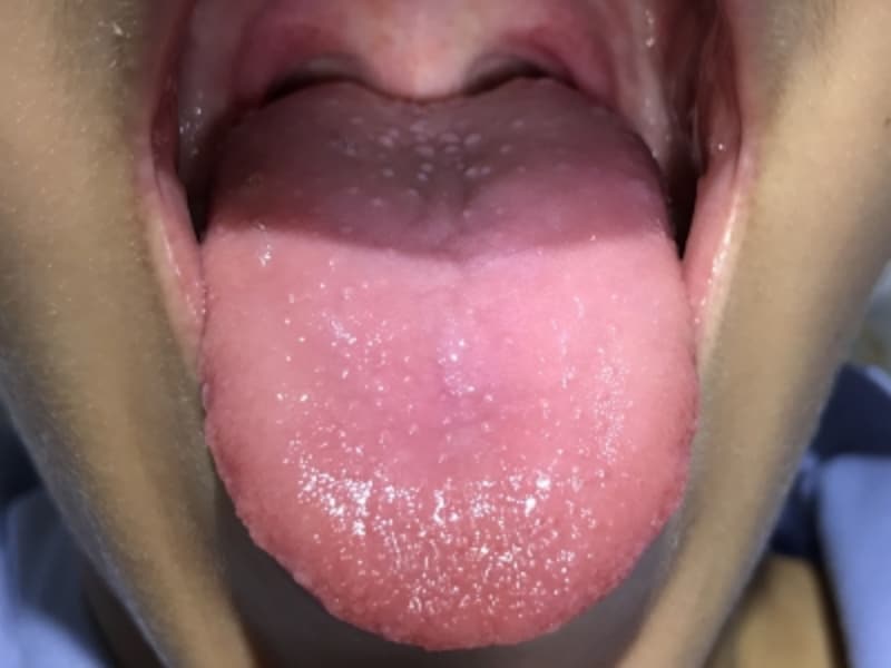 舌 の 奥 白い ブツブツ