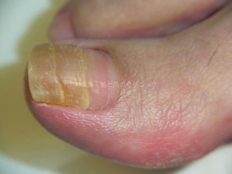 足の爪が分厚くなる病気 爪甲鉤彎症とは 皮膚 爪 髪の病気 All About