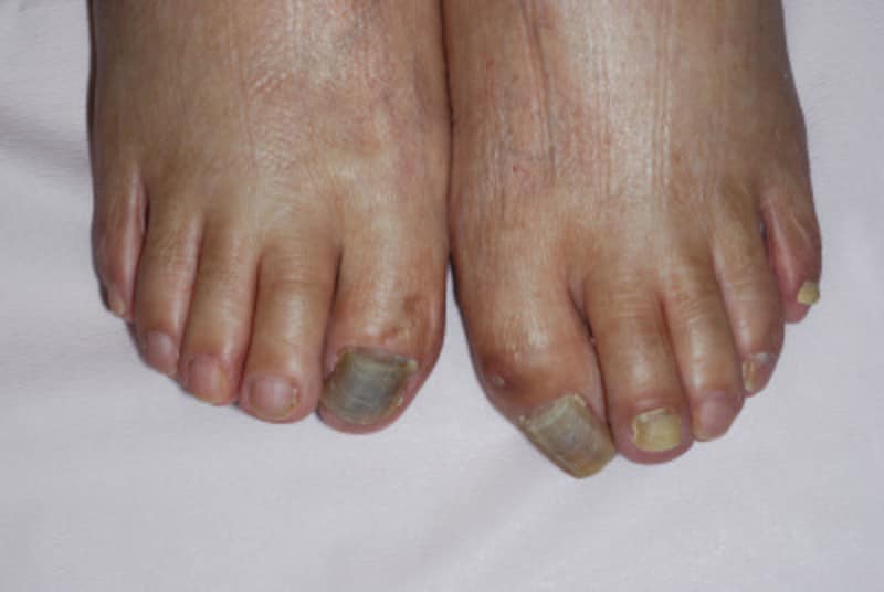 症例画像あり 爪甲鉤彎症とは 足の爪が分厚くなる原因 症状 治療法 予防法 皮膚 爪 髪の病気 All About