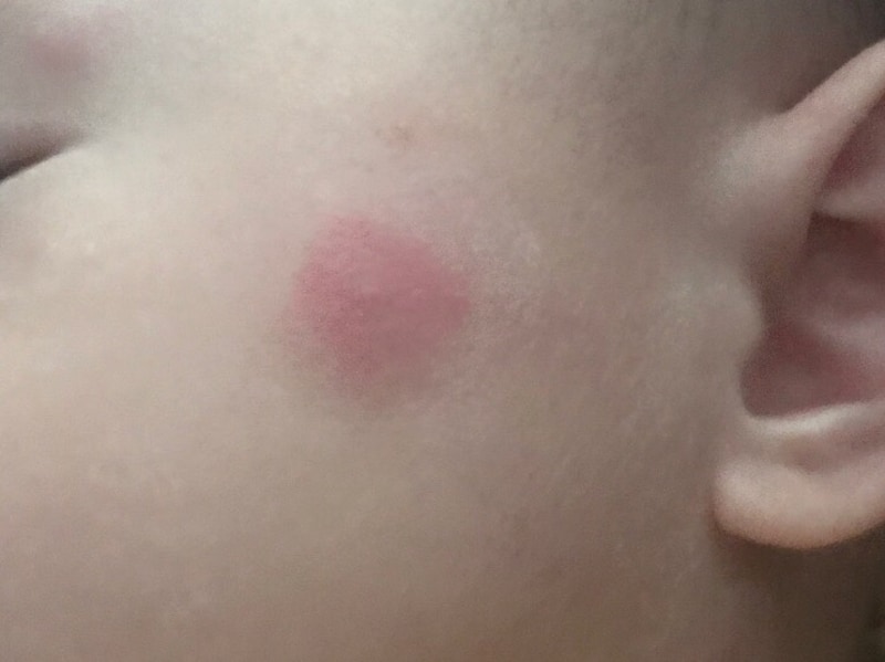 疥癬がひどい場合