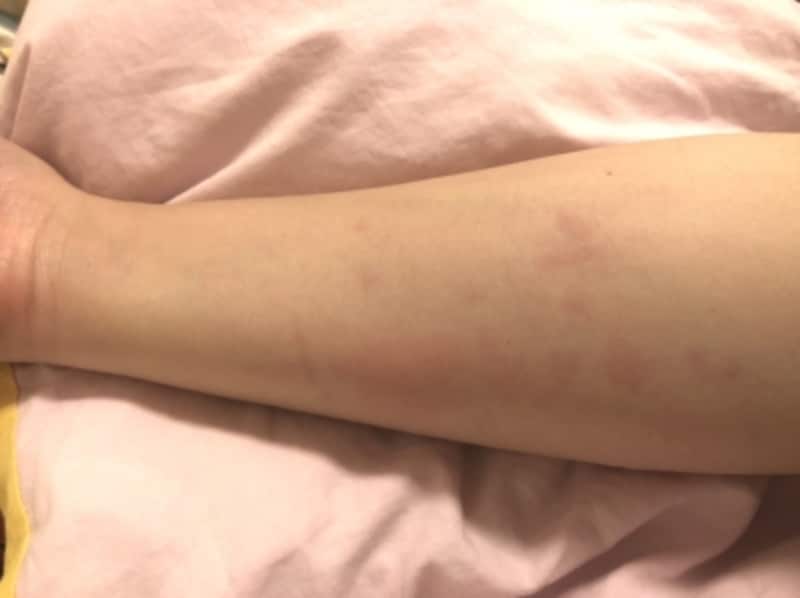 症例画像 虫刺されの症状 対処法 ひどい腫れや痒みも 皮膚 爪 髪の病気 All About