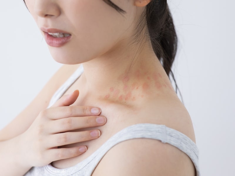体に痒みのある赤い発疹が出る蕁麻疹。発疹が全身に広がることもあります