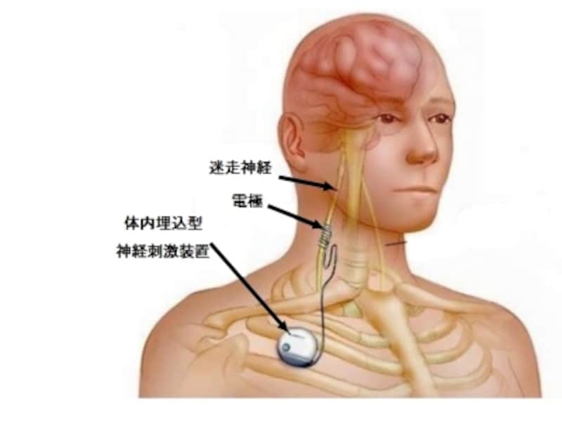 神経刺激