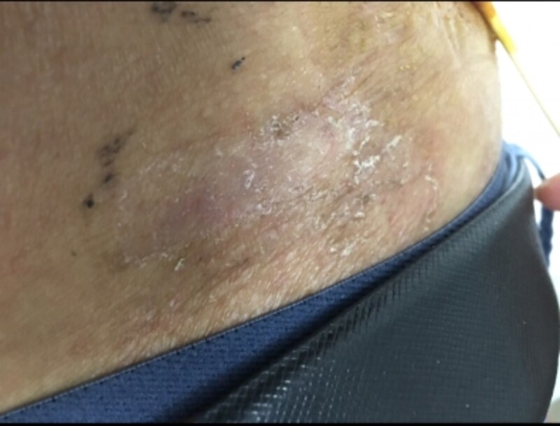 ステロイドの塗り薬 外用薬 の種類 効果 副作用 皮膚 爪 髪の病気 All About