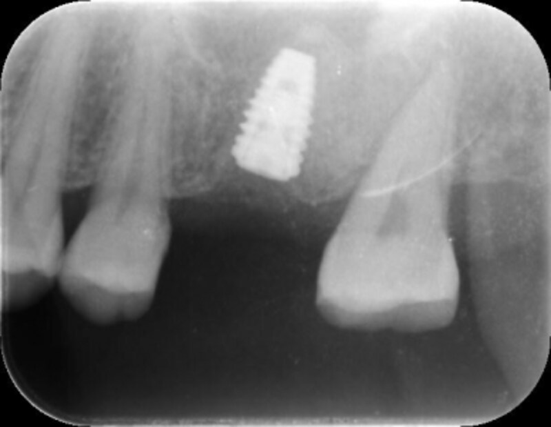 下顎大臼歯部に比べて難易度が高くなる上顎大臼歯部のインプラント。