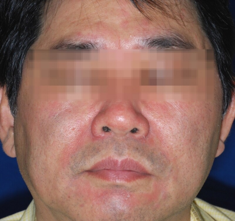 脂漏性皮膚炎の症例画像・写真・成人