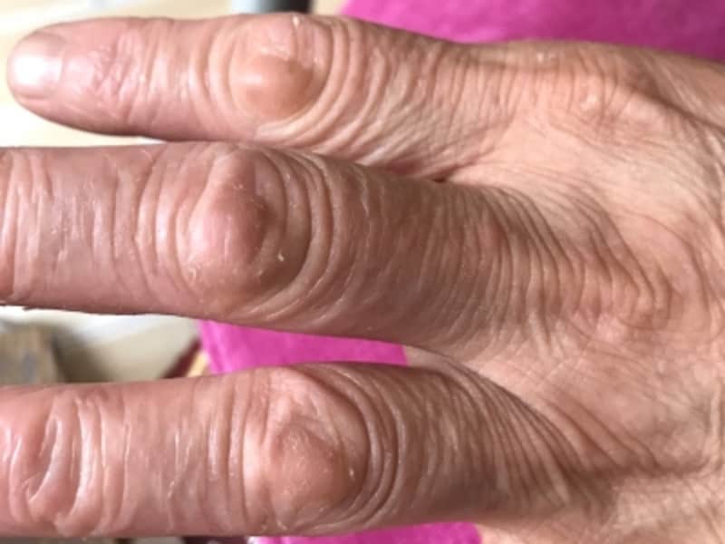 手湿疹の症状 原因 治し方 症例画像あり 皮膚 爪 髪の病気 All About