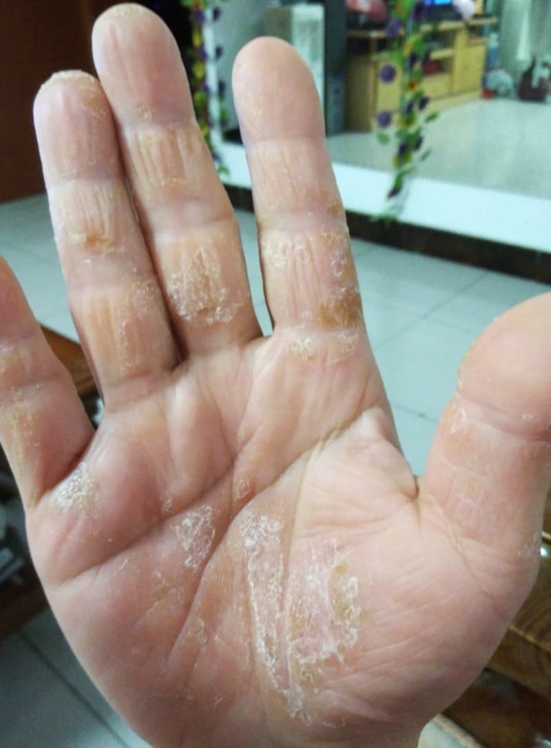 かゆみ 手のひら 手湿疹の治し方…症例写真・症状・原因・治療法 [皮膚・爪・髪の病気]