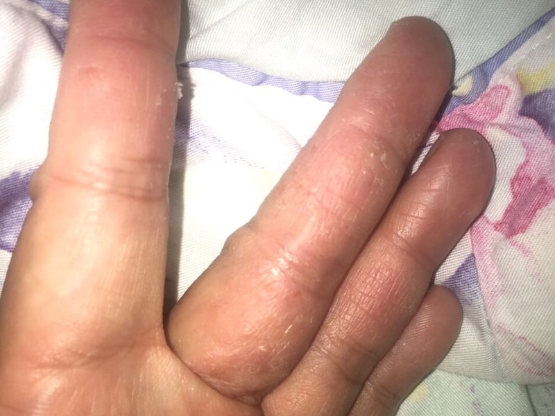 病気 手 の 皮 が むける 指の皮がむける原因とは？７つの原因と３つの病気の可能性について