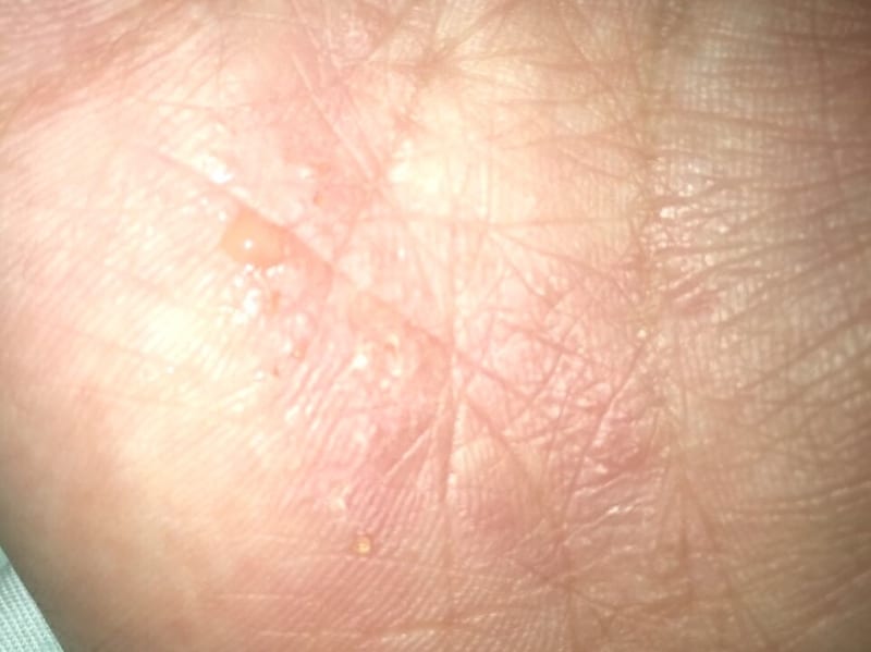 病気 手 の 皮 が むける 手の皮がむける原因は病気かも～この症状に当てはまる？