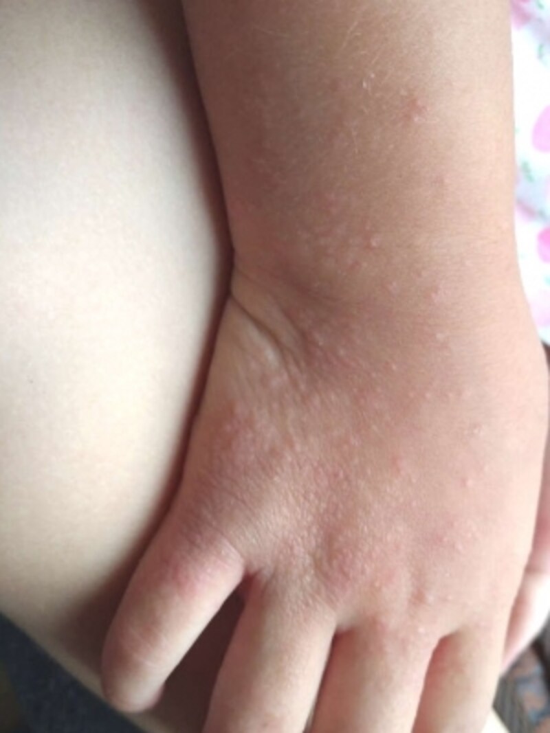 手湿疹の症状 原因 治し方 症例画像あり 皮膚 爪 髪の病気 All About